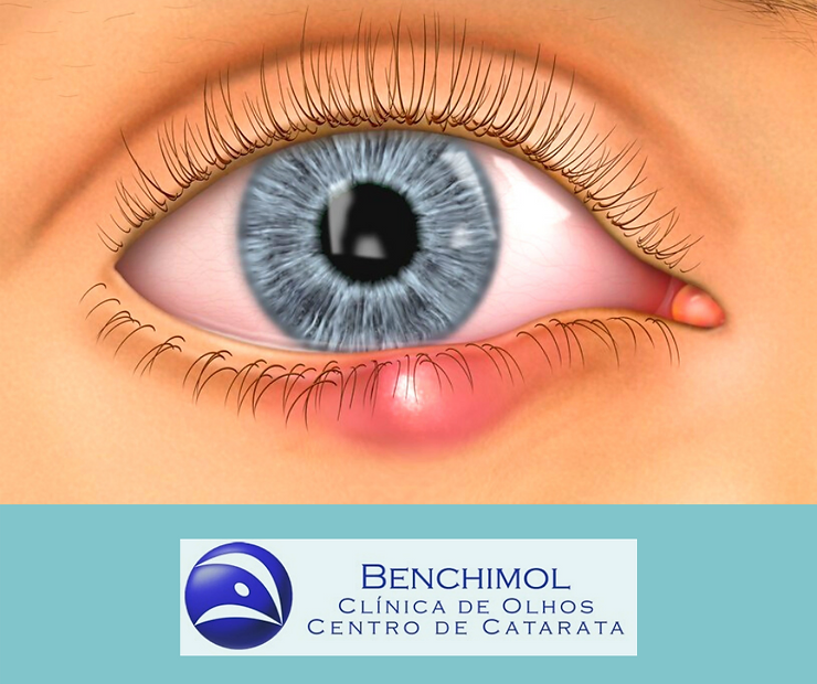 Terçol O que é Clínica de Olhos Benchimol